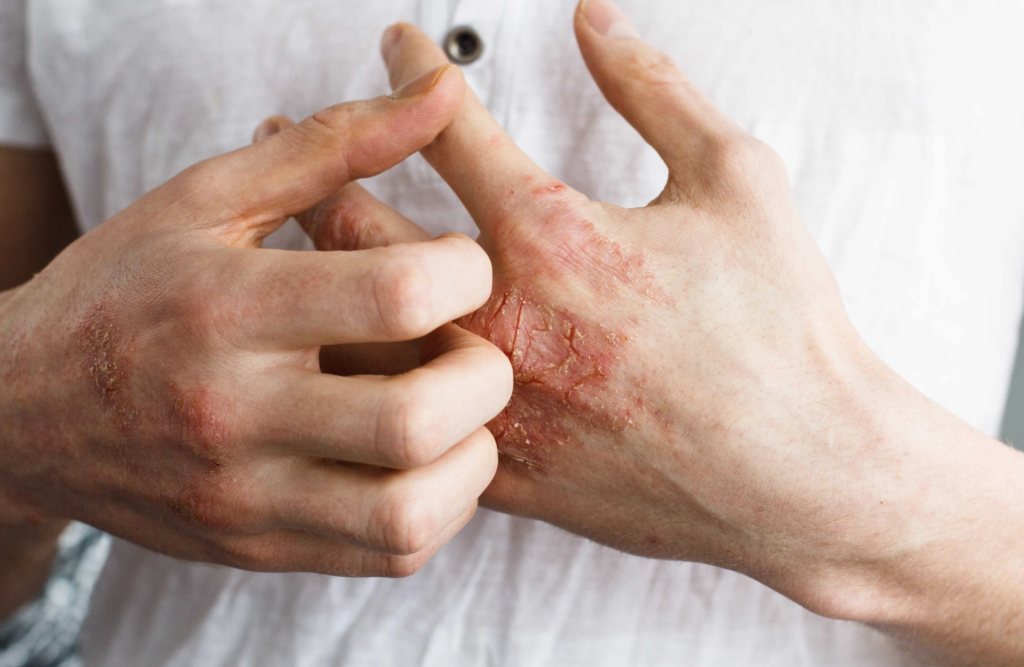 What is the most effective treatment for Eczema?              