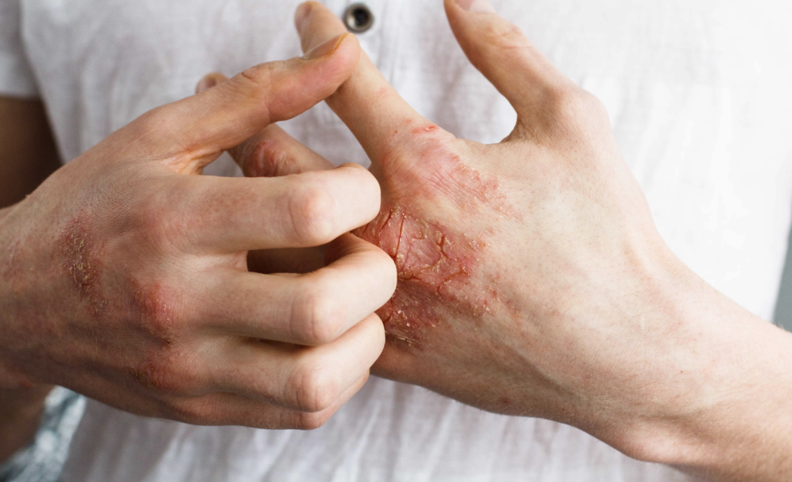 What is the most effective treatment for Eczema?              